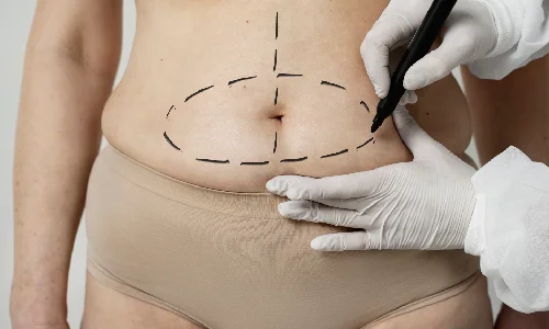 Abdominal Liposuction | Plastic Surgery Indian