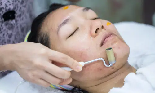 Anti-Pigmentation Peel | Plastic Surgery India