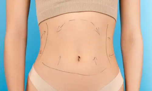 Body Lift | Plastic Surgery Indian