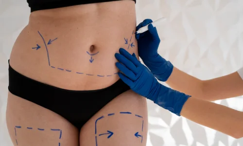 Vaser Liposuction | Plastic Surgery Indian