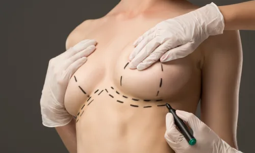 Breast Augmentation Surgery | Plastic Surgery Indian 
