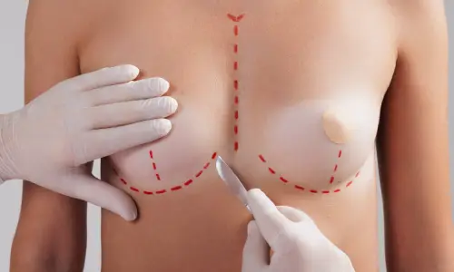 Breast Lift (Mastopexy) | Plastic Surgery Indian