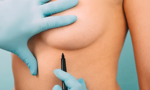 When do you need a Breast Reduction Surgery? | Plastic Surgery Indian