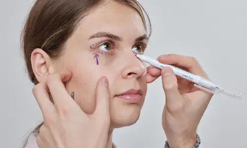 Canthoplasty | Plastic Surgery Indian
