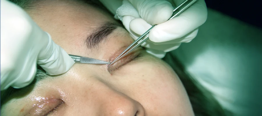 Eyelid Surgery | Plastic Surgery Indian 