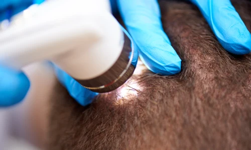 FUT Hair Transplant | Plastic Surgery Indian