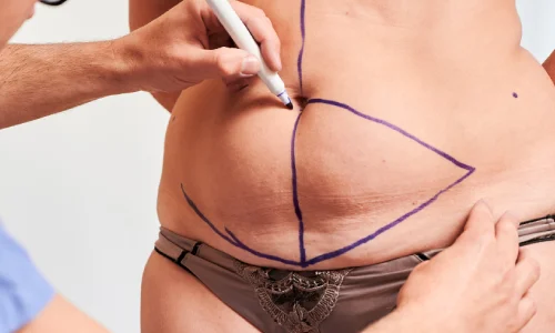 Full Abdominoplasty | Plastic Surgery Indian