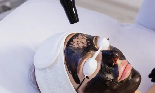 Laser Carbon Facial | Plastic Surgery India