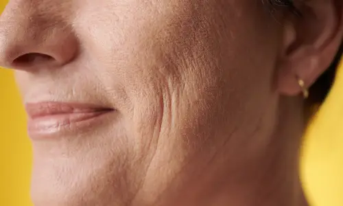 Laser Wrinkle Reduction | Plastic Surgery India