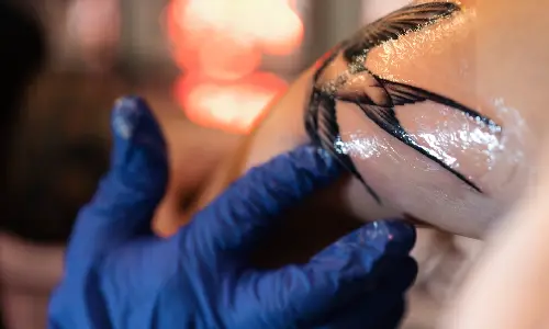 Non-Surgical Tattoo Removal | Plastic Surgery India