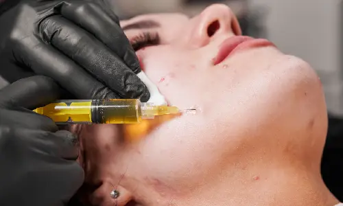 PRP for Skin Rejuvenation | Plastic Surgery India