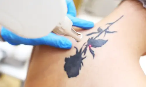 Permanent Tattoo Removal | Plastic Surgery India