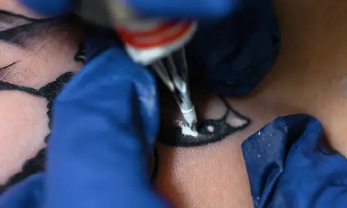 Q-Switched Laser Tattoo Removal | Plastic Surgery India