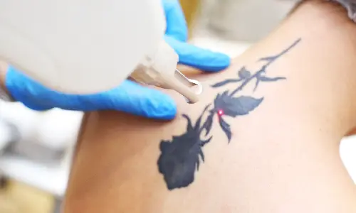Tattoo Removal