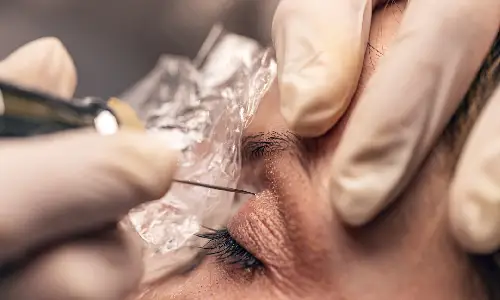 Under-Eye Fillers | Plastic Surgery Indian