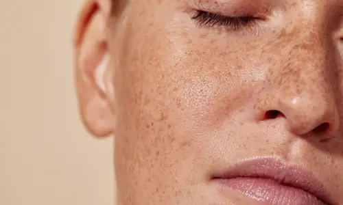 Carbon Facial for Pigmentation | Plastic Surgery India