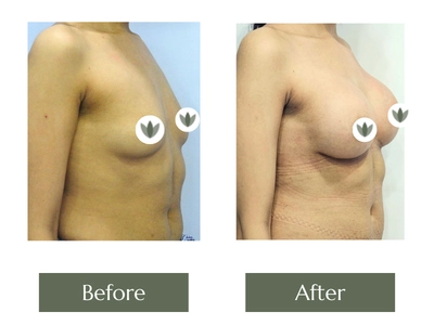 Breast Enlargement