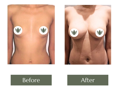 Breast Enlargement