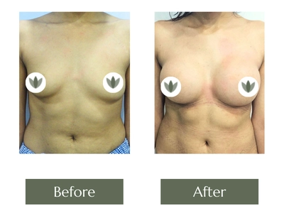 Breast Enlargement