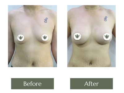 Breast Enlargement