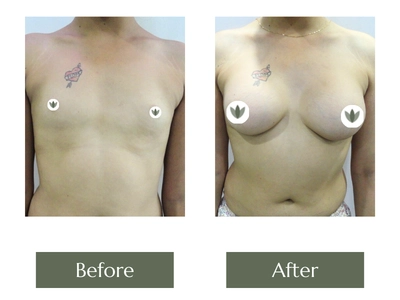Breast Enlargement