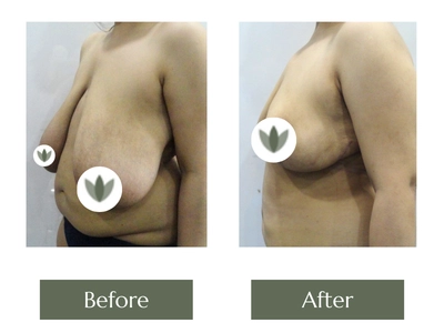Breast Lift