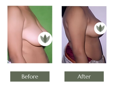 Breast Lift