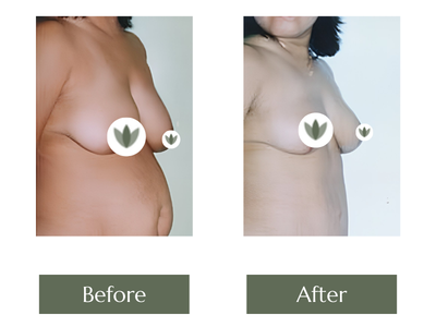 Breast Lift