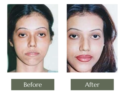 Chin Augmentation