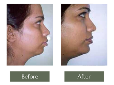 Chin Augmentation