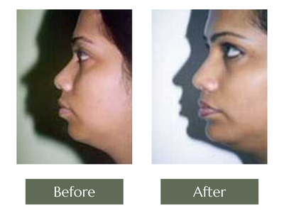 Chin Augmentation