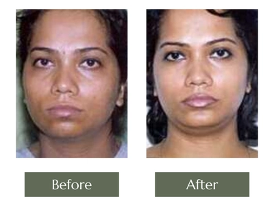 Chin Augmentation