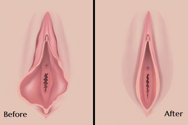 Genital Aesthetic Surgery