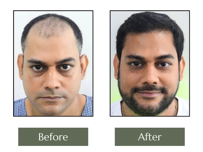 Hair-Transplant