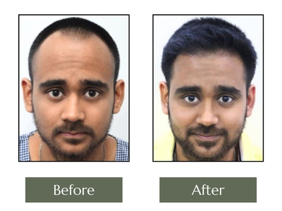 Hair-Transplant