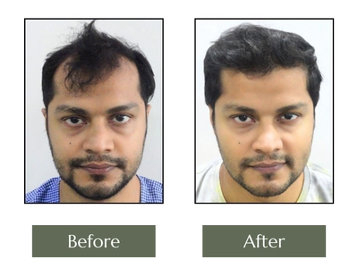 Hair-Transplant