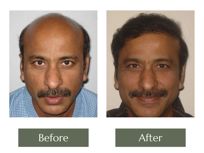 Hair-Transplant