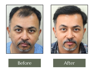 Hair-Transplant