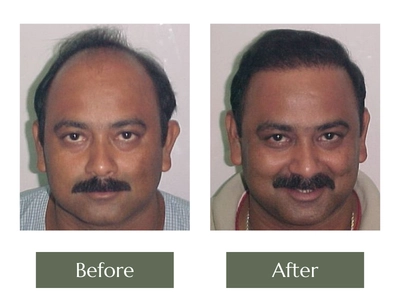 Hair-Transplant