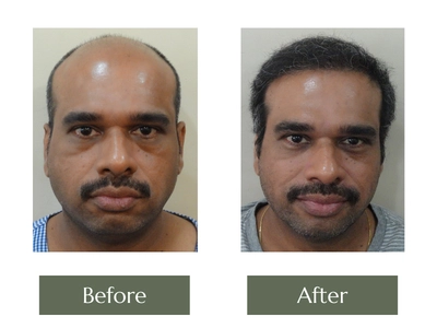 Hair-Transplant