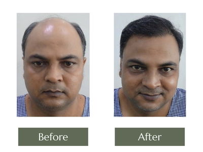 Hair-Transplant