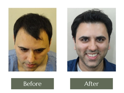 Hair-Transplant