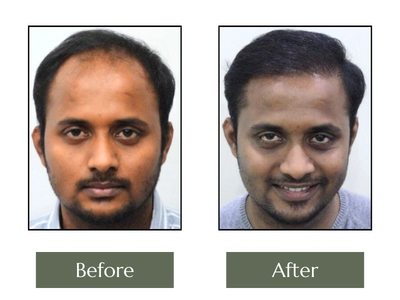 Hair-Transplant