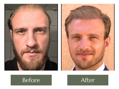 Hair-Transplant