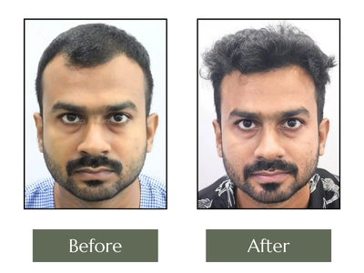 Hair-Transplant
