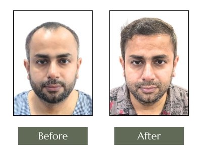 Hair-Transplant