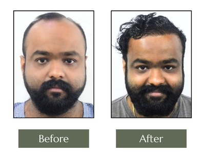 Hair-Transplant