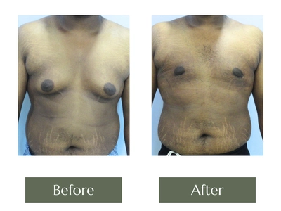 Male Breast Reduction