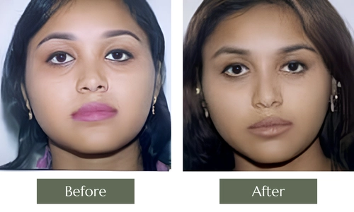 Nose Surgery
