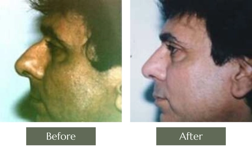 Nose Surgery
